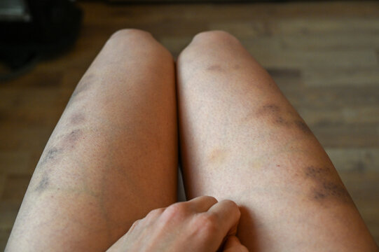 Violence against women.
Woman with bruises on her legs. Girl with injuries on her body. Bruises on a woman's body.