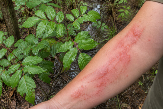 Severe Poison Ivy Rash with Blisters on Forearm After Urushiol Exposure