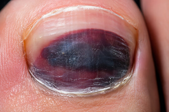 Dark Bruised Fingernail With Blood Under Nail Close Up Medical Condition