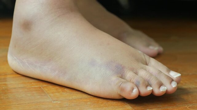 Close up of swollen foot with bruise on floor showing signs of injury and inflammation in motion clip