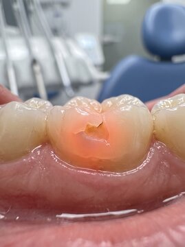 Close-up view of a human molar tooth undergoing a dental diagnostic procedure using transillumination light to detect dental decay or cracks