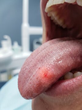 Close-up view of a sore red lesion on the lateral border of a human tongue during a dental checkup examination