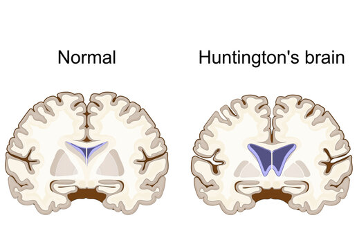 Huntington's brain comparison. Huntington disease HD. Huntingtons chorea. Fatal neurodegenerative inherited disease.