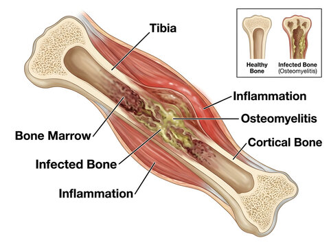 Tibia bone with osteomyelitis inflammation and infection illustration isolated on white background