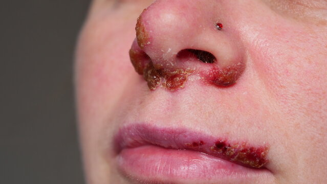 Close-up of a person's nose and lips with cold sores and skin irritation