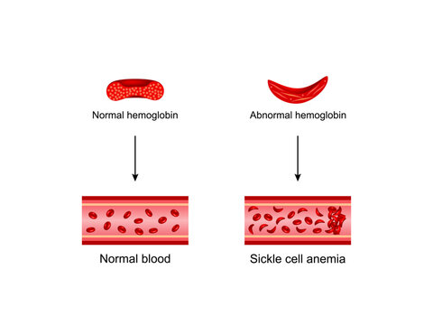 Sickle cell disease. Normal blood and Sickle cell anemia,. Gene mutation. Vector illustration.