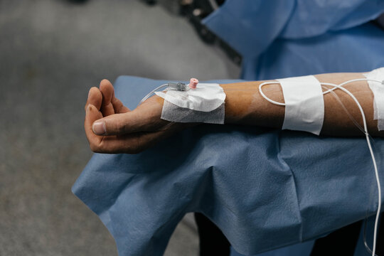Patient arm with arterial and venous catheters secured before surgery, illustrating preoperative preparation, anesthesia induction, invasive monitoring, and perioperative care.