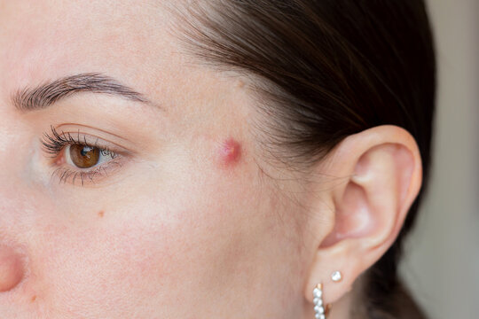 Close up of a young caucasian woman face with rosacea symptoms, red inflamed papule on temple, sensitive skin condition.