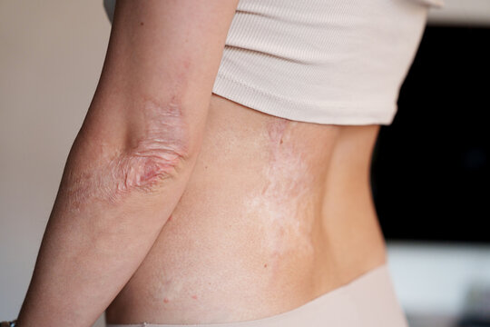 Burn scars on woman back and elbow shown as skin healing detail