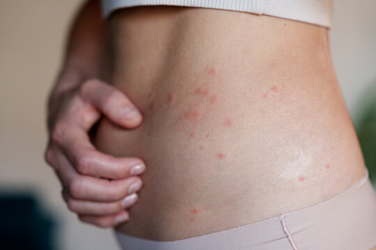 Woman scratching itchy red rash on side as skin irritation symptom