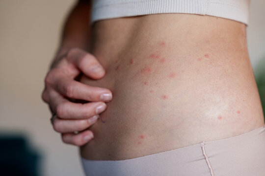 Woman scratching itchy red rash on side as skin irritation symptom