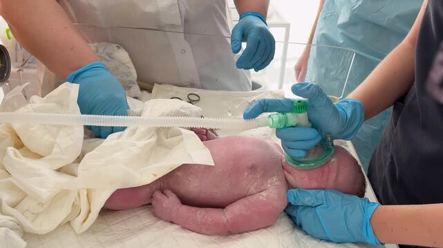 Medical staff in a delivery room performing emergency resuscitation on a newborn infant with a breathing mask, providing life-saving oxygen support immediately after birth in the clinic