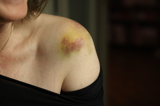 Ecchymose jaune et violette sur une &eacute;paule