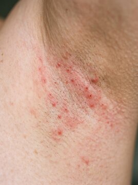 Macro view of a red skin rash and inflammation in a human armpit for medical education, dermatological health articles, and skincare treatment brochures.