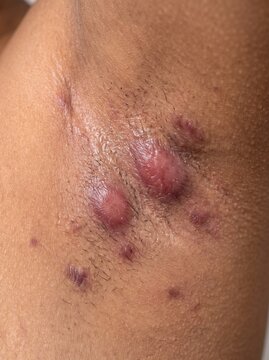 Detailed view of Hidradenitis Suppurativa nodules and chronic scarring in the axilla for medical textbooks, dermatological patient education, and healthcare website backgrounds.