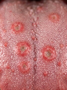Macro view of multiple canker sores and ulcers on a human tongue for medical textbooks, healthcare educational materials, and clinical diagnostic resources.