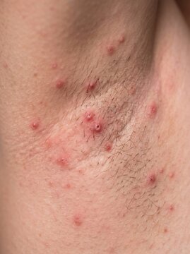 Macro view of skin inflammation and pustules in a human armpit area for medical education, dermatological health blogs, and clinical diagnostic guides.