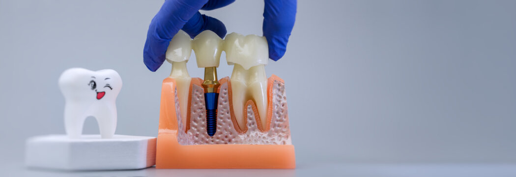Dentist holding bridge on implant model. Friendly stomatology clinic banner background.