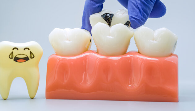 Dentist Hand Opening Tooth Crown to Reveal Deep Hidden Cavity on Dental Model with Crying Character