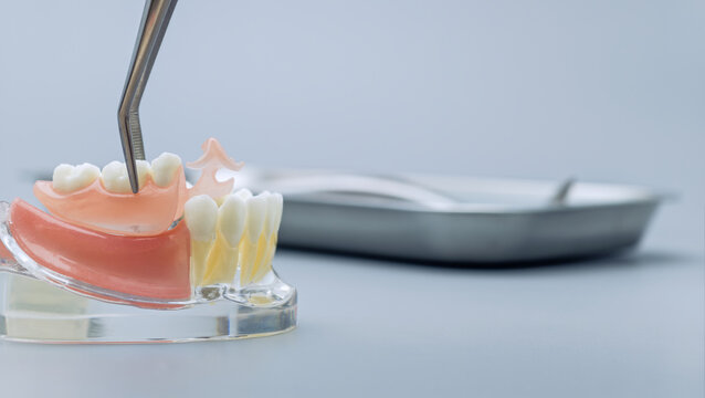 Dental prosthodontics concept: Tweezers placing a flexible partial artificial teeth prosthesis on a jaw model.