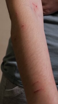 Detailed close up of a human arm covered in fresh scratches, bloody cuts, and bite marks resulting from an aggressive cat attack, highlighting the painful and visible skin trauma