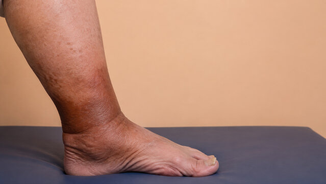Lipodermatosclerosis on lower leg of patient showing chronic venous insufficiency and skin discoloration