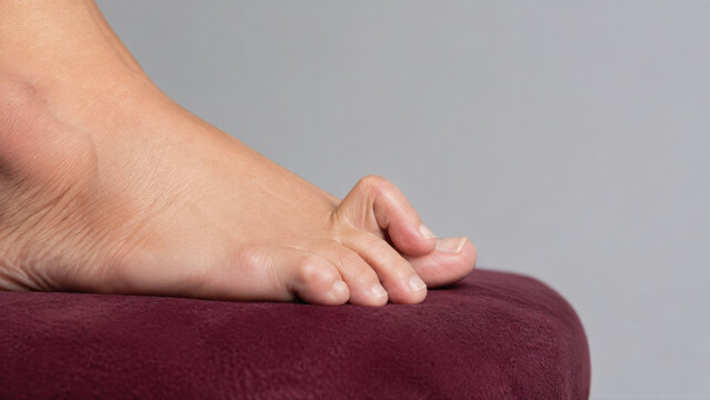 Hammer toe deformity on human foot resting on cushion, medical foot condition close up