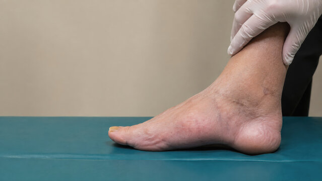 Medical examination of a charcot foot showing bone and joint changes on examination table