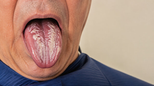 Oral candidiasis showing white patches on human tongue close up for medical diagnosis