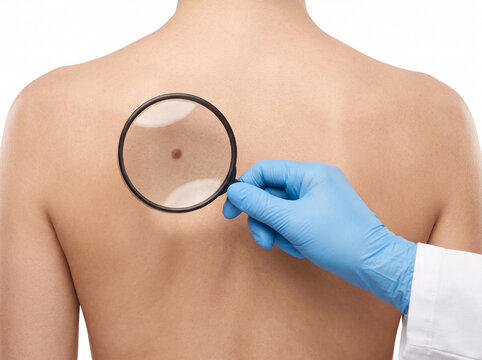 dermatologist using round magnifying lens to inspect benign mole on far left side of woman upper back on white