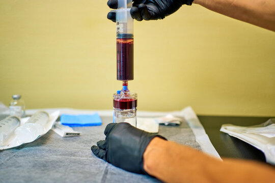Medical professional preparing PRP syringe and vial.