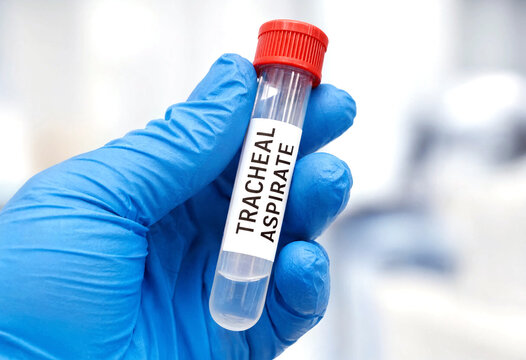 Medical professional holding test tube labeled tracheal aspirate for respiratory sample analysis in laboratory setting