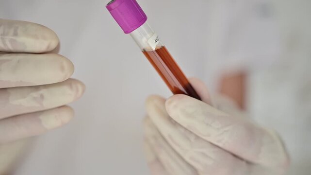 Cola-colored urine, a dark brown to reddish-brown urinary fluid with abnormal pigmentation, described in clinical medicine and laboratory diagnostics as an altered urine specimen

