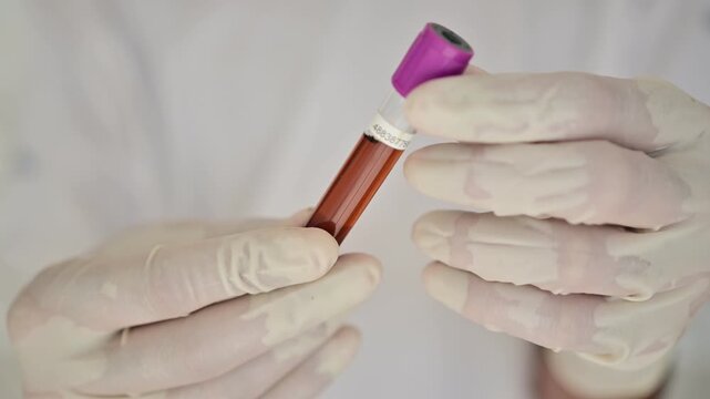 Gastric aspirate, a biological fluid collected from the stomach containing gastric secretions, hydrochloric acid, mucus, enzymes, electrolytes, partially digested food, and cellular material

