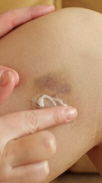 Close up view of a hand applying a healing ointment on a large purple bruise on a person's leg, gently rubbing the topical gel into the injured skin for treating the hematoma and contusion