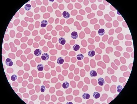 Microscopic view of blood smear showing atypical mononuclear cells, leucocytes. Medical laboratory slide contains red blood cells, white cells for pathology research. Hematology specimen under light