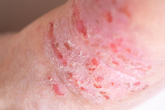 dermatitis allergic reactions, itchy skin on leg, closeup injured female limb damaged reddened skin scratches, wound on painful female leg, chronic dermatological disorder, skin problem, affected area