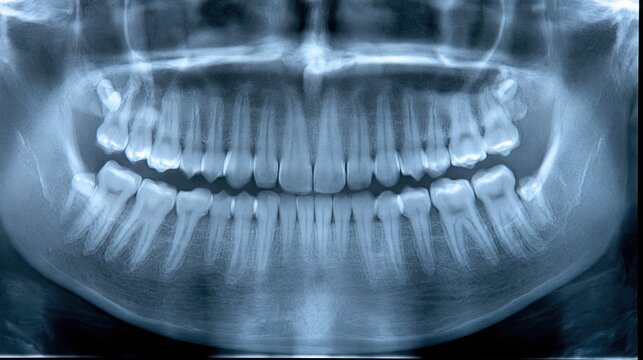dental x-ray showing human teeth and jawbone structure