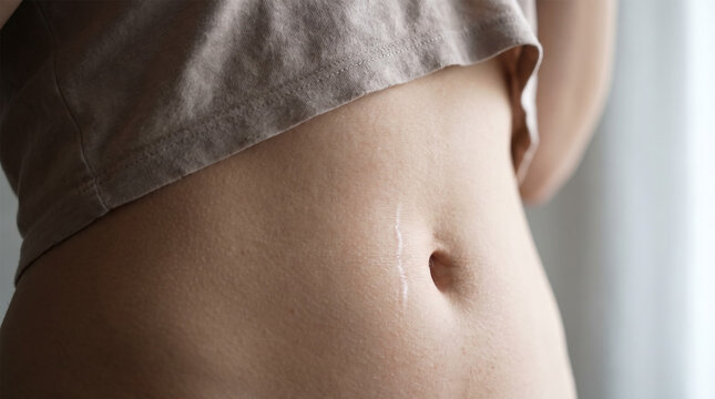 Close Up of Woman Stomach with Healed Vertical Laparotomy Scar Above Navel