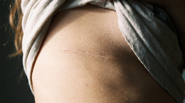 Close Up of Woman Ribcage with Healed Horizontal Thoracic Surgical Scar