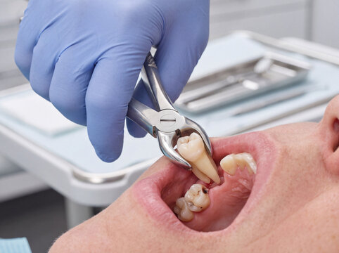 Professional Tooth Extraction Procedure Using Dental Forceps for Molar Removal and Oral Surgical Dental Treatment