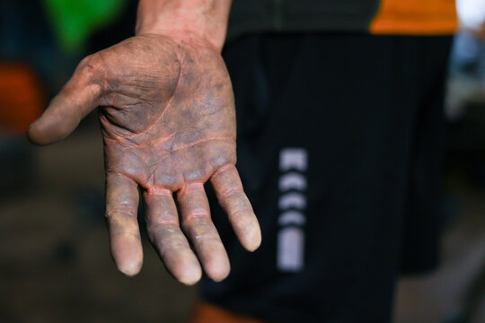 Injured hand bruised palm worn skin pain manual work close up injury worker physical strain shown on dirty open palm with rough callus and tired gesture