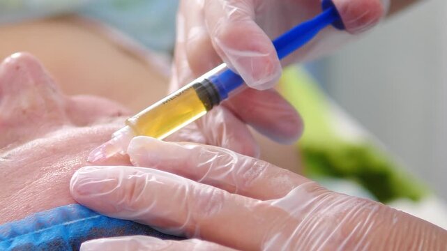 Cosmetologist hand in glove holding syringe with yellow plasma, injecting into skin of woman face. Regenerative treatment, natural rejuvenation, anti-aging, aesthetic medicine 4k video