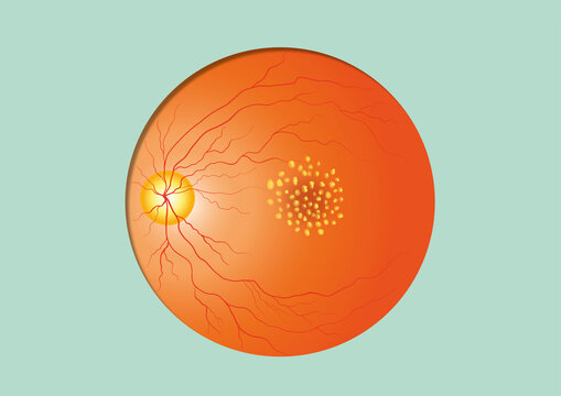 Dry macular degeneration, illustration