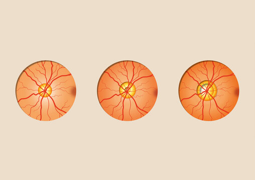 Glaucoma, illustration