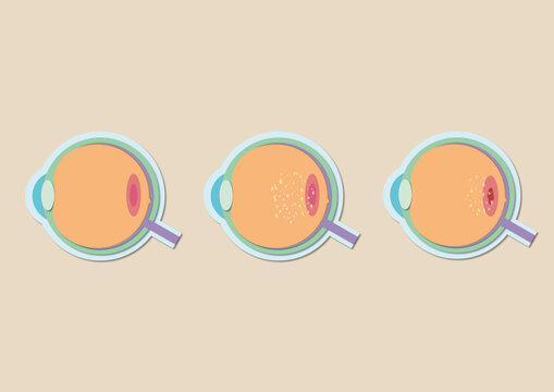 Macular degeneration, illustration