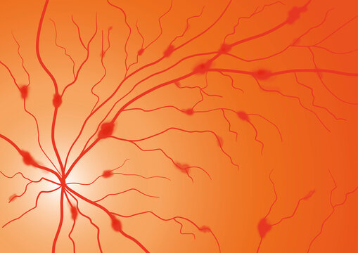 Retinal vein occlusions, illustration