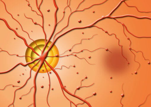 Retina pigmentosa, illustration
