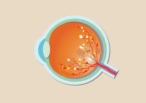Diabetic retinopathy, illustration
