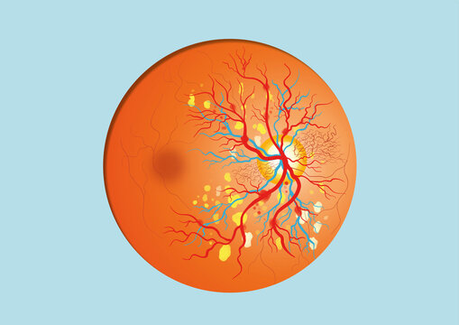 Diabetic retinopathy, illustration